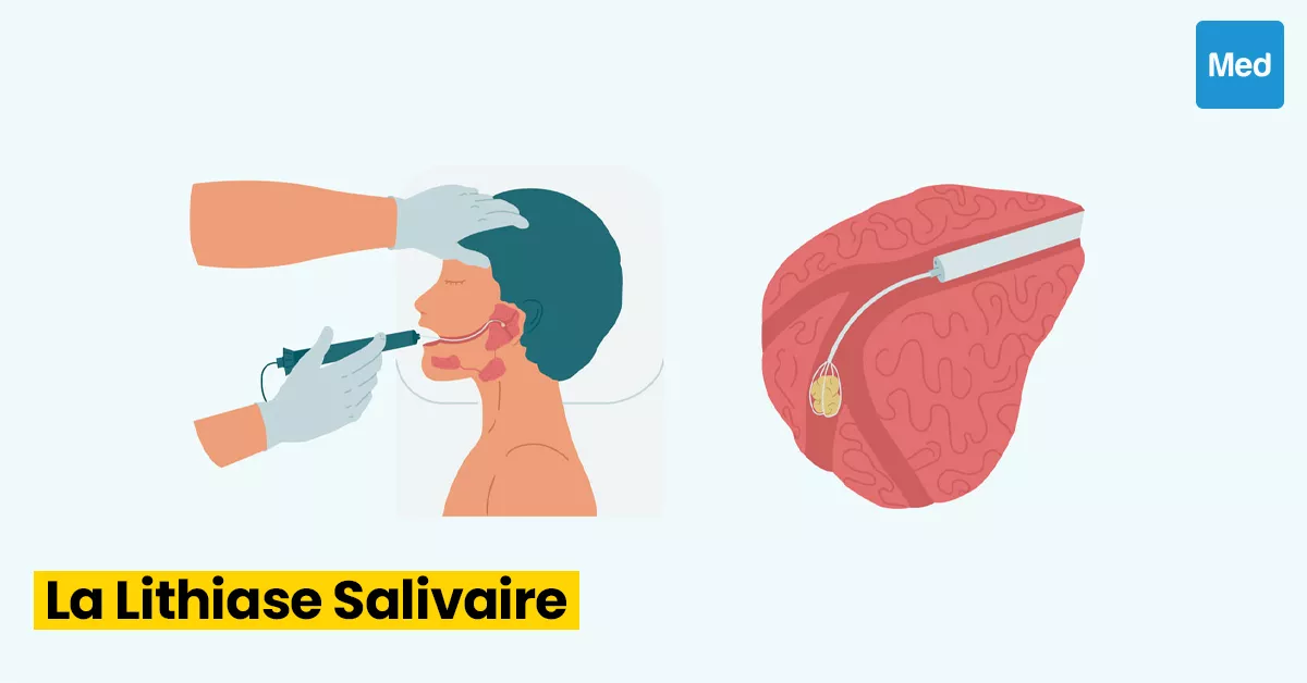 Lithiase salivaire : causes, symptômes et traitements